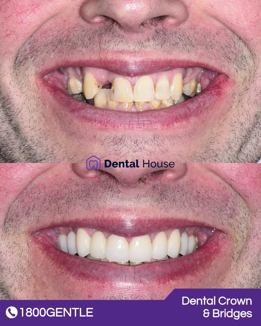 Dental Crown & Bridges