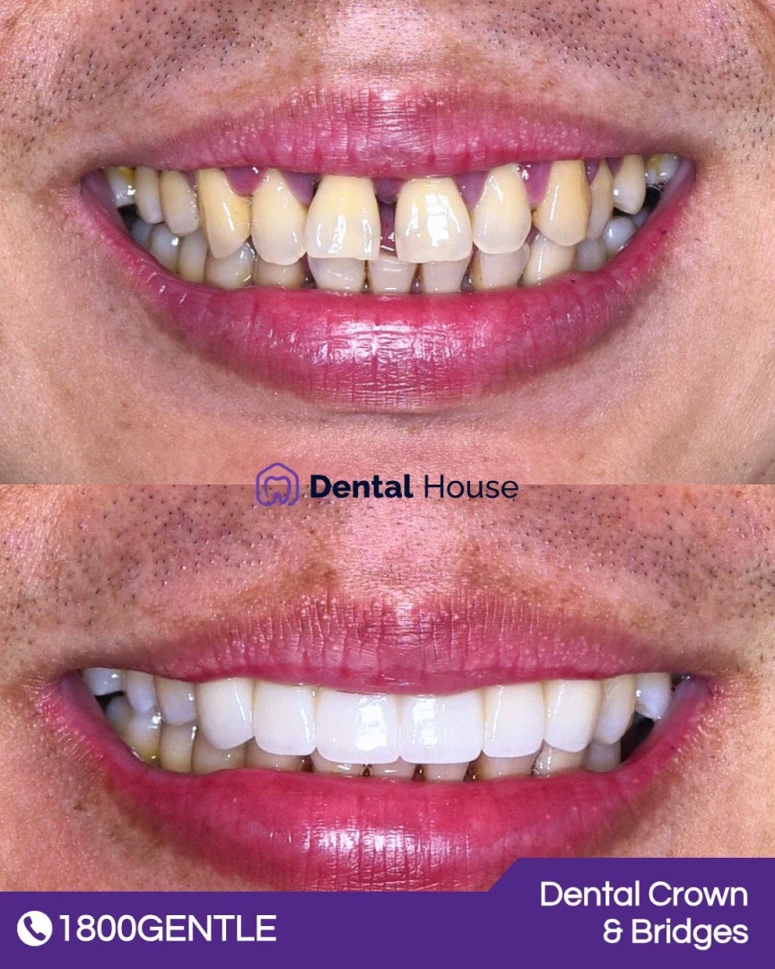Dental Crown & Bridges