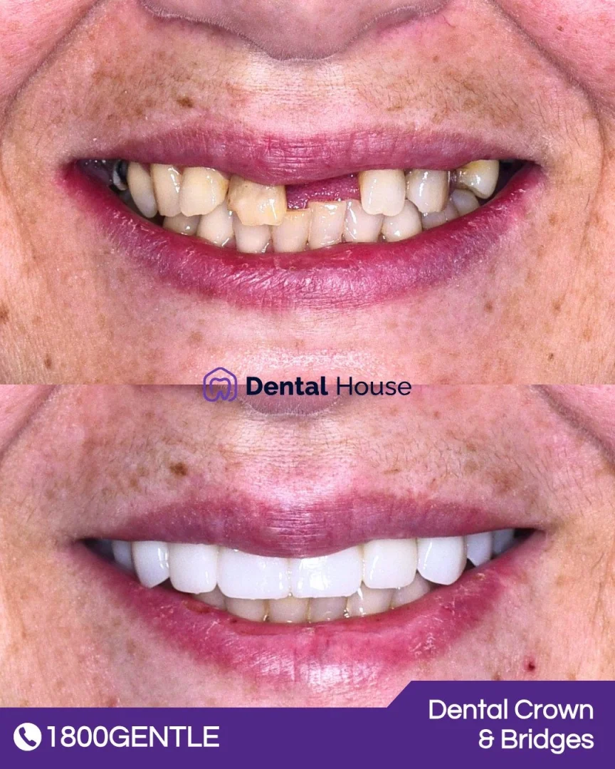 Dental Crown & Bridges
