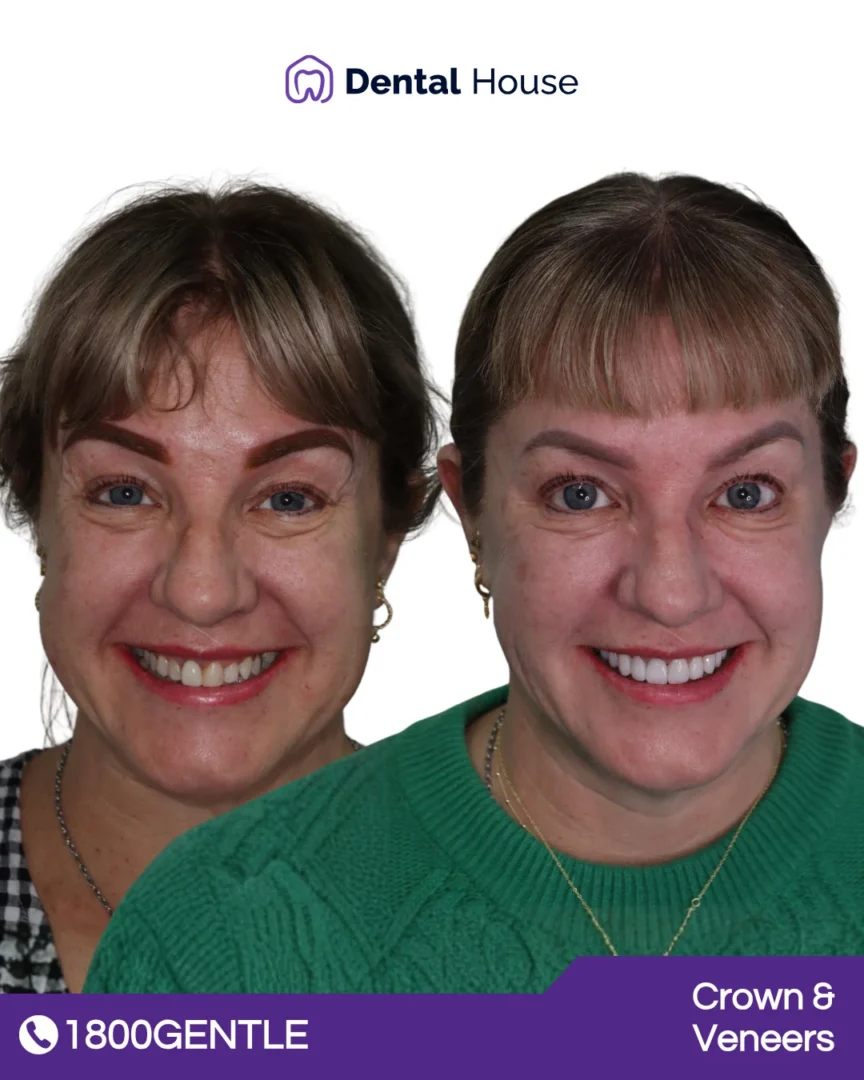 Dental Crown & Veneers