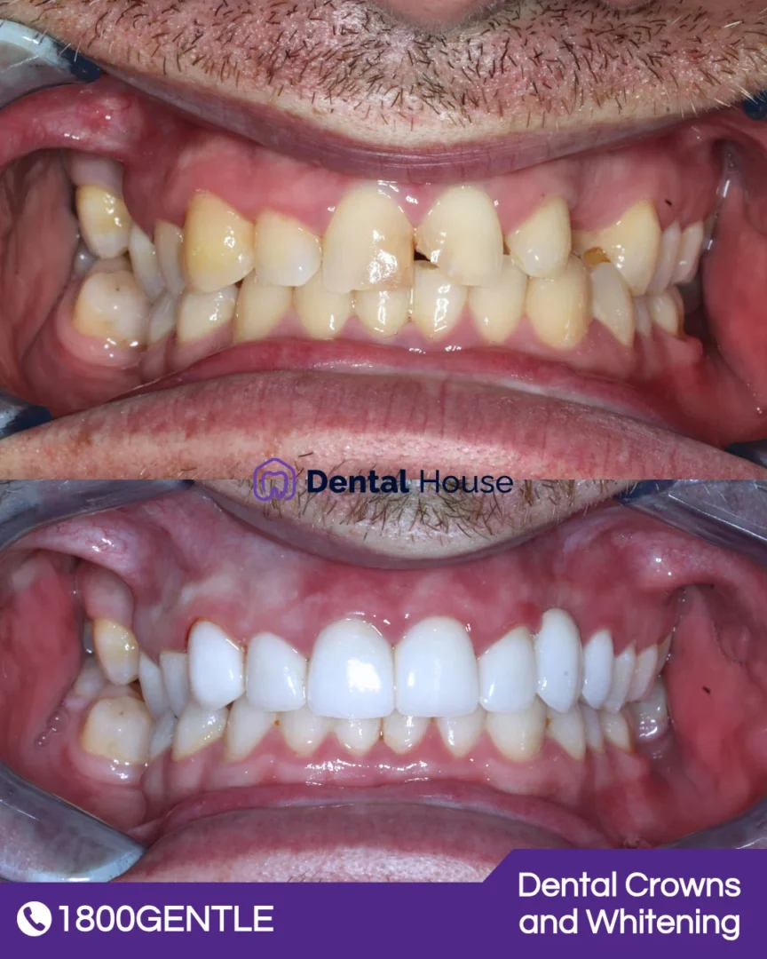 Dental Crowns and Whitening