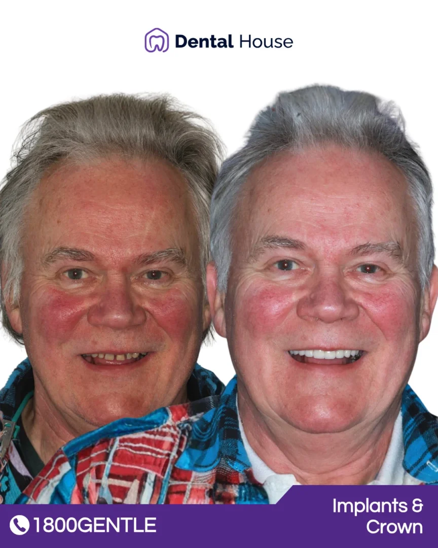 Dental Implants & Crown