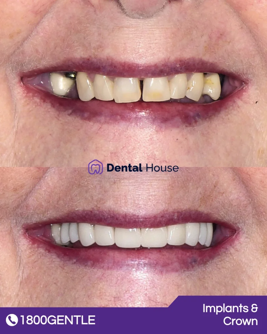 Dental Implants & Crown
