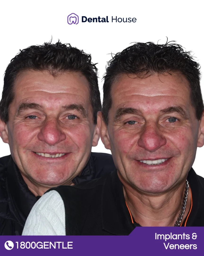Dental Implants & Veneers