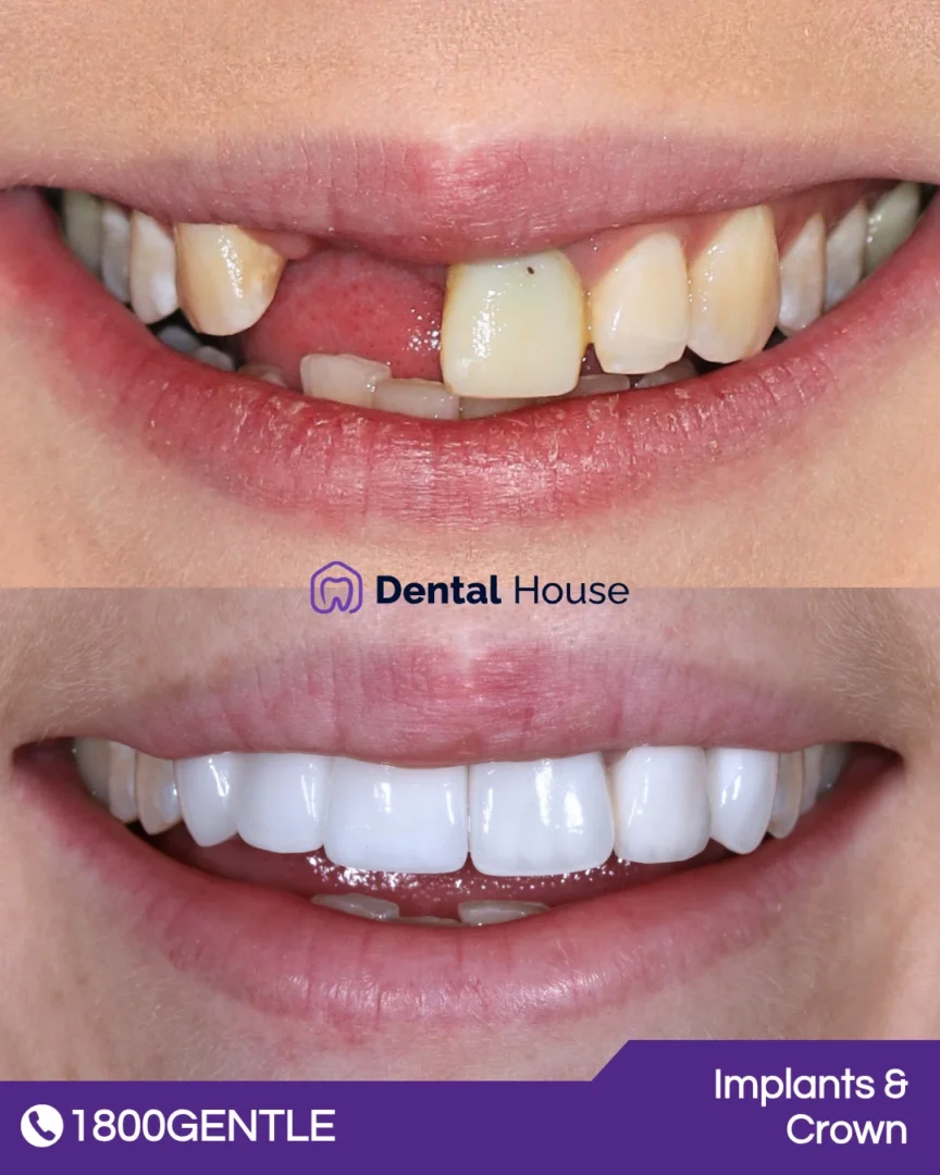 Dental Implants & Crown