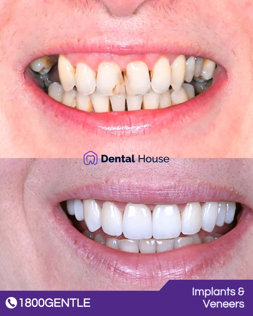 Dental Implants & Veneers