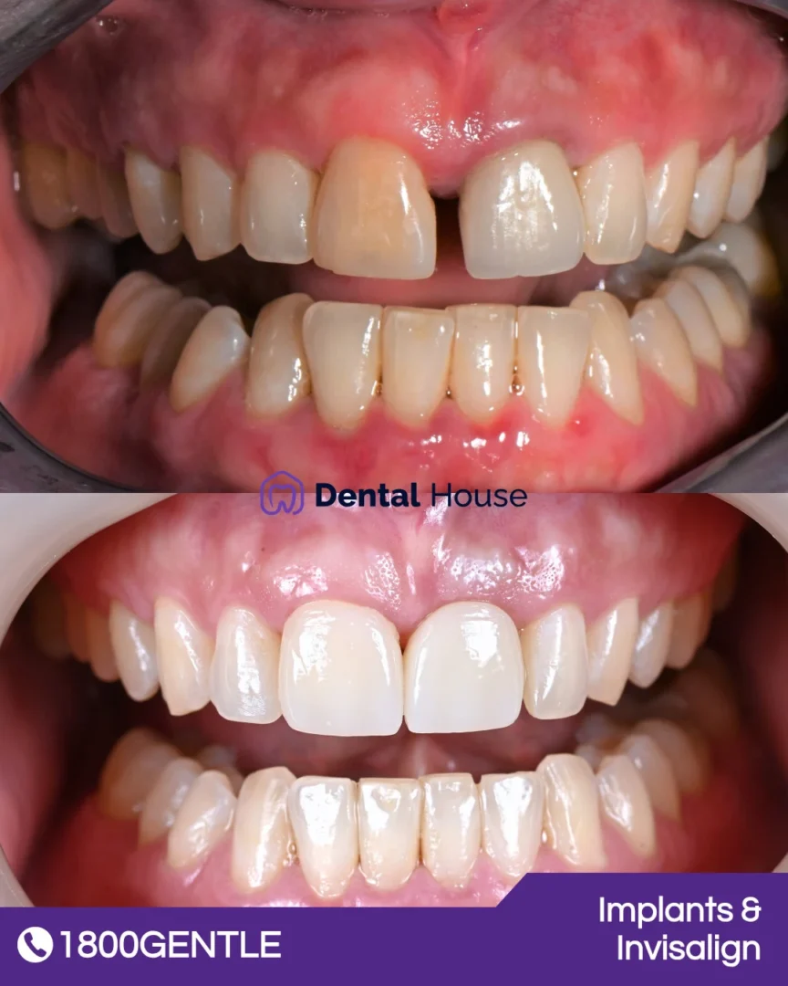Implants & Invisalign