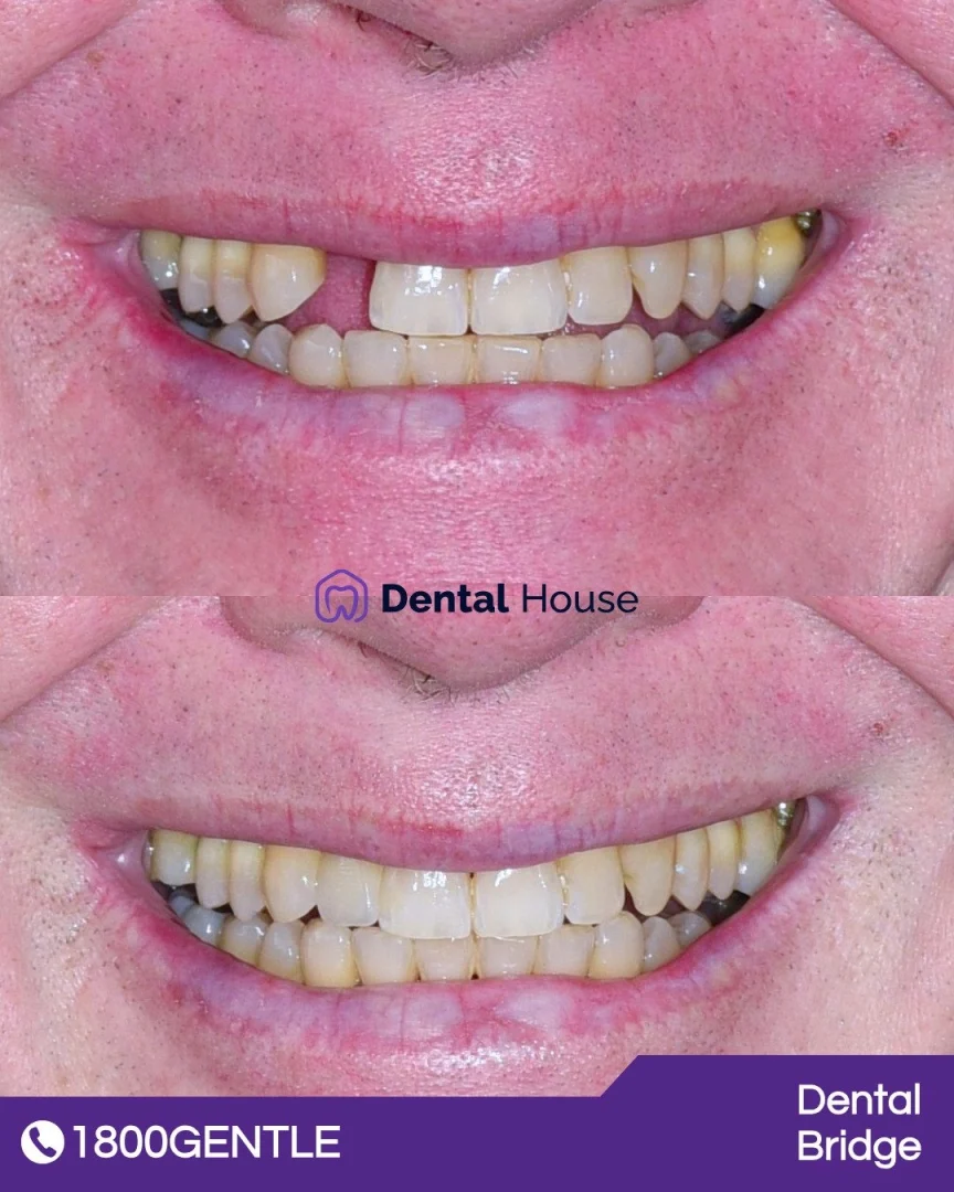 Dental Bridge
