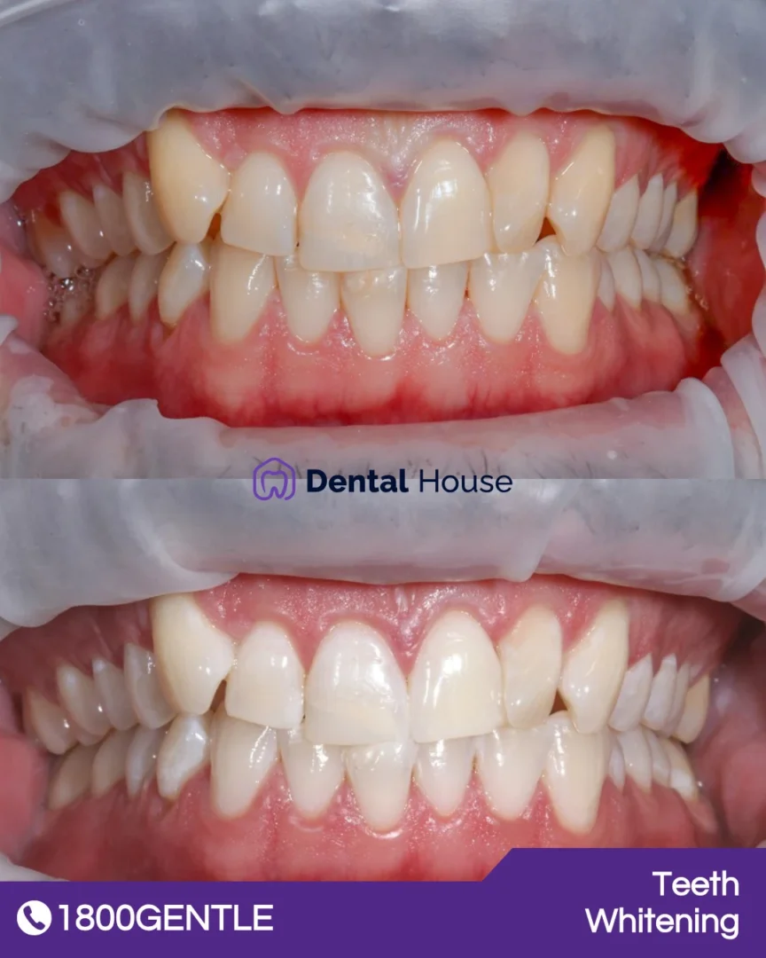 Teeth Whitening