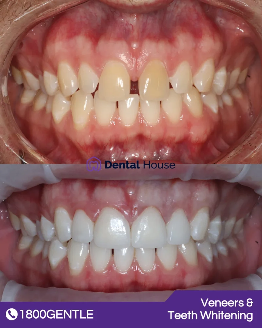 Veneers & Whitening