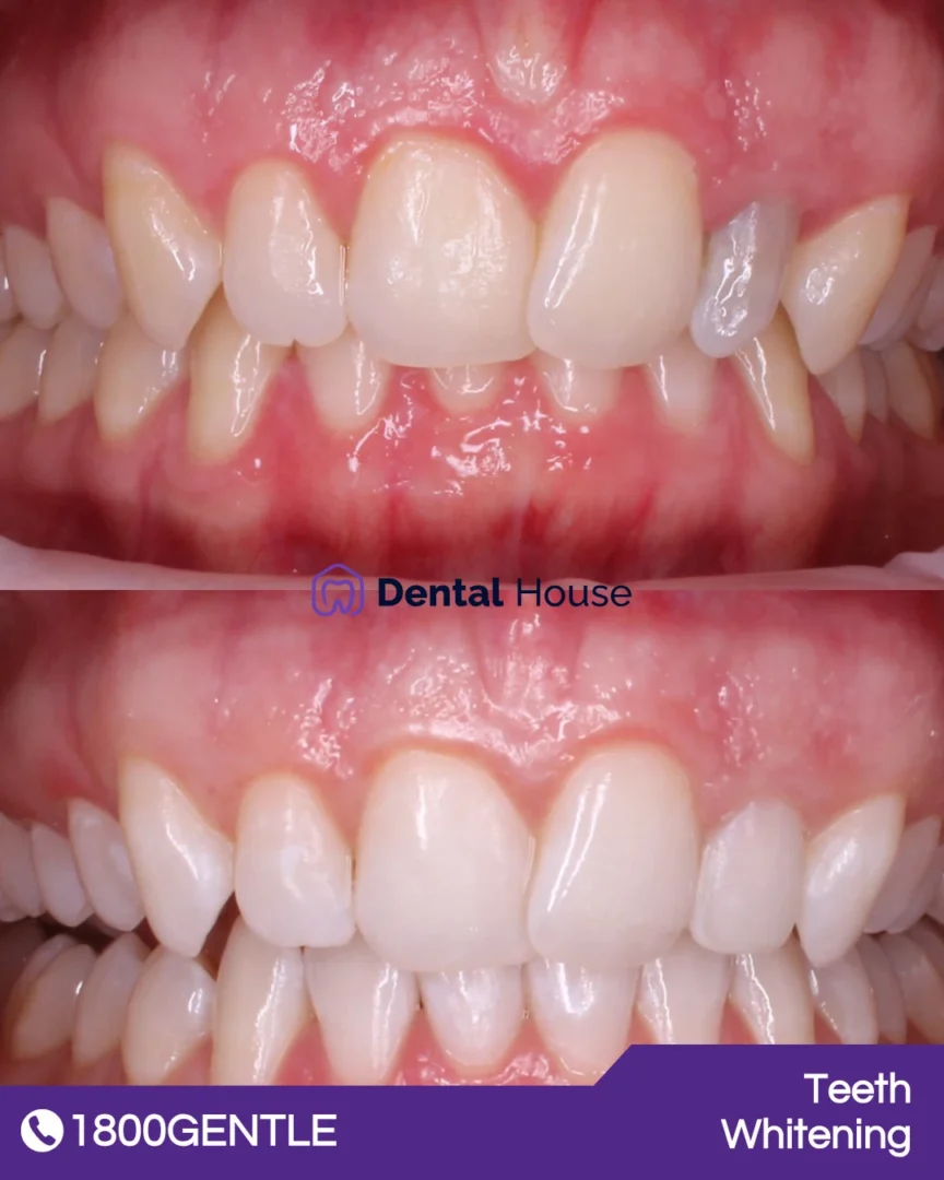 Teeth Whitening