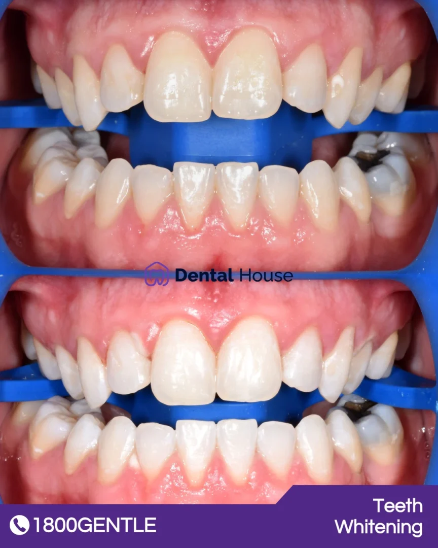 Teeth Whitening