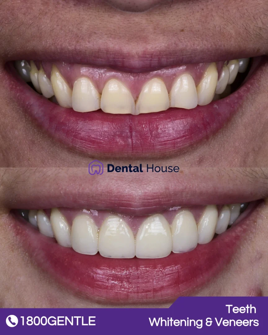 Teeth Whitening & Veneers