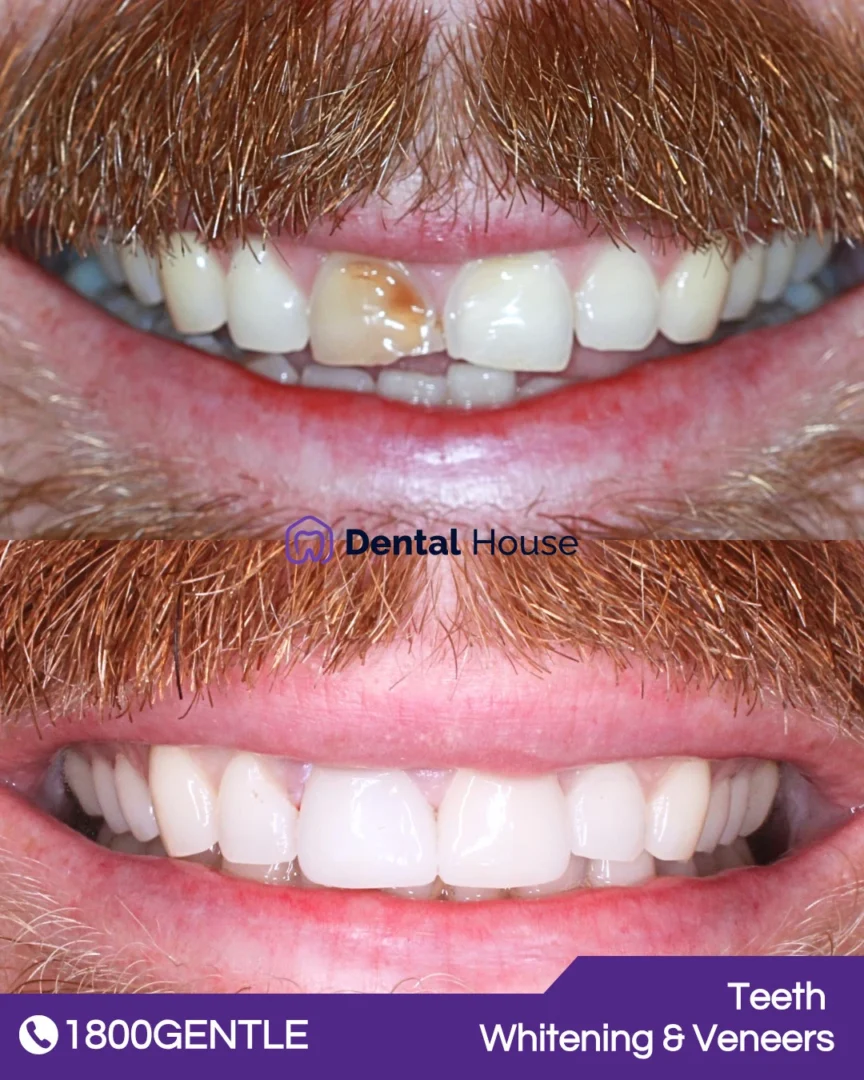 Teeth Whitening & Veneers