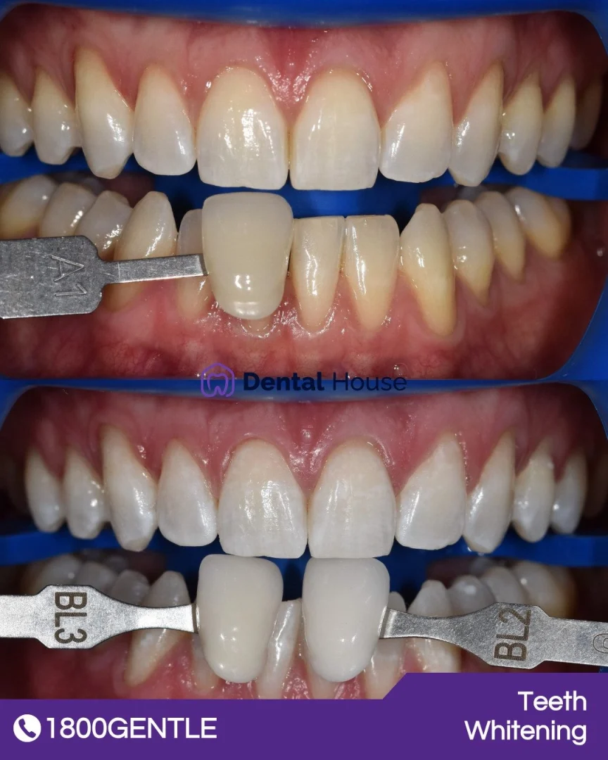 Teeth Whitening