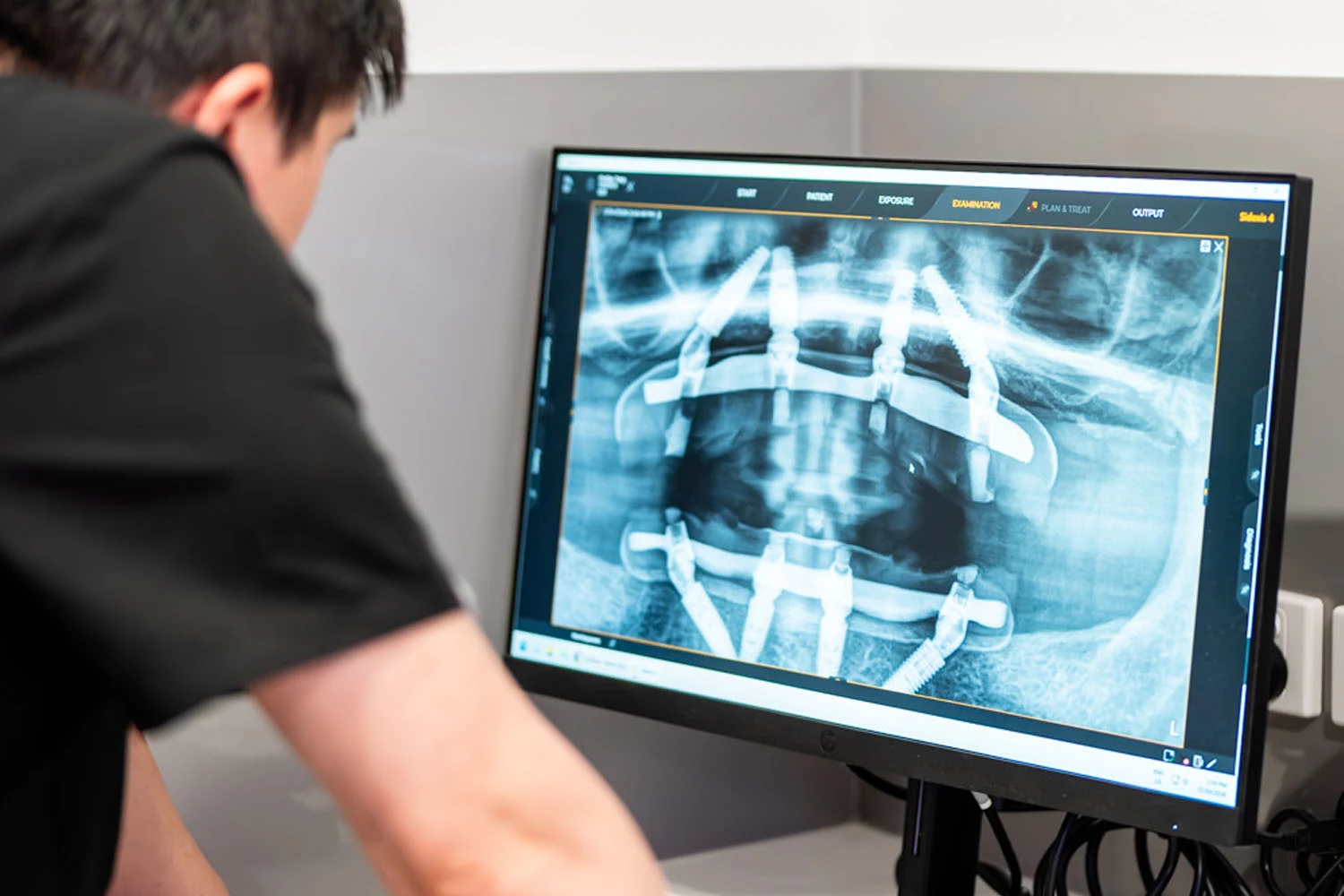 What Is All On 4 Plus®? Dentist checking All on 4 x-ray photo